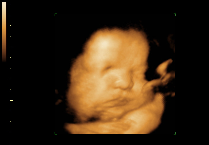 3D ultrasound image at 32 weeks